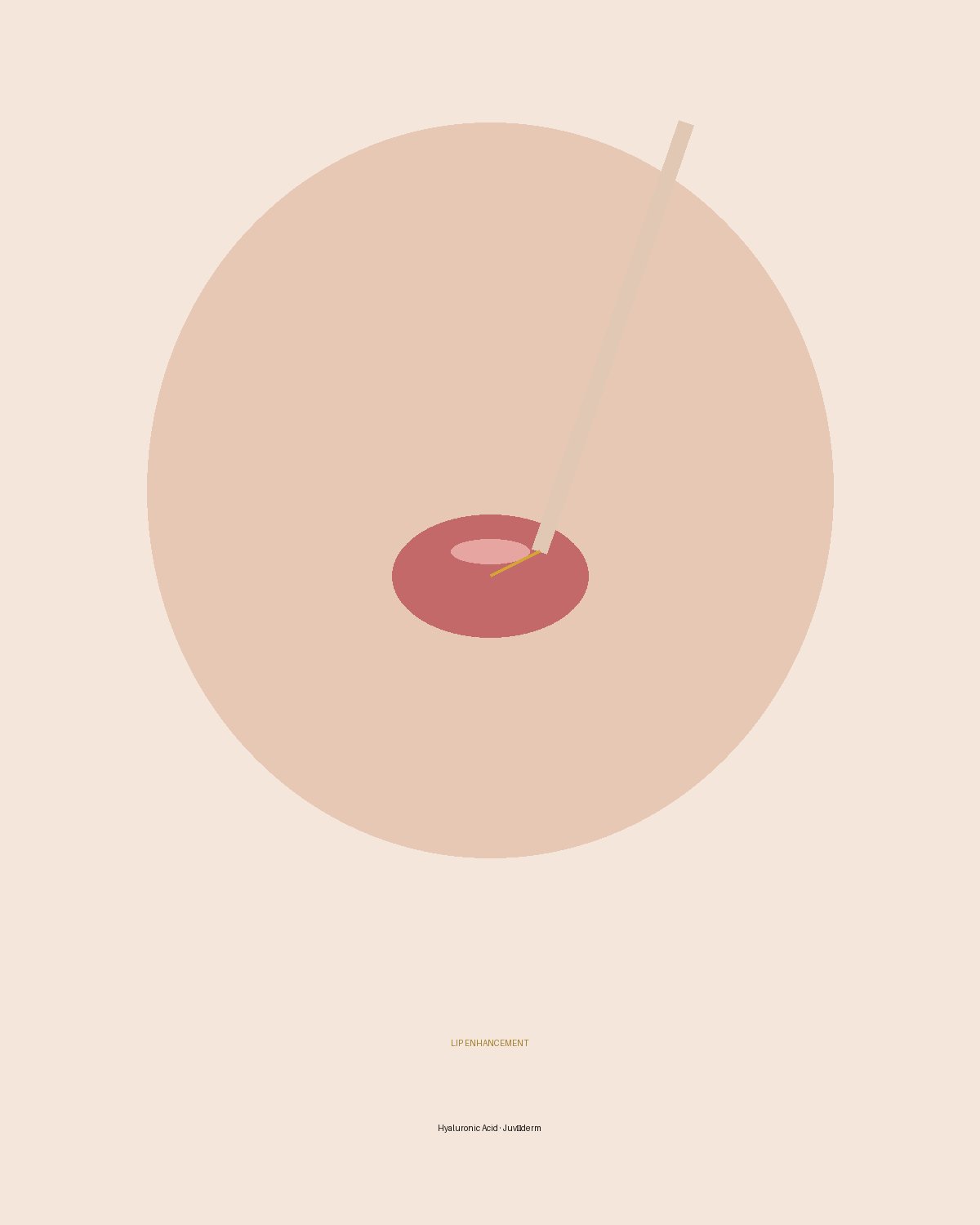 Lip enhancement with Juvéderm